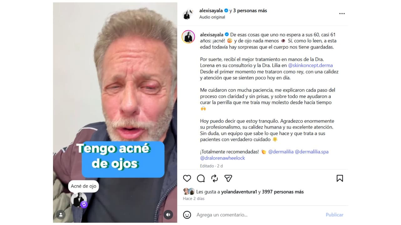 Alexis Ayala fue operado tras ser diagnosticado con acné en los ojos.