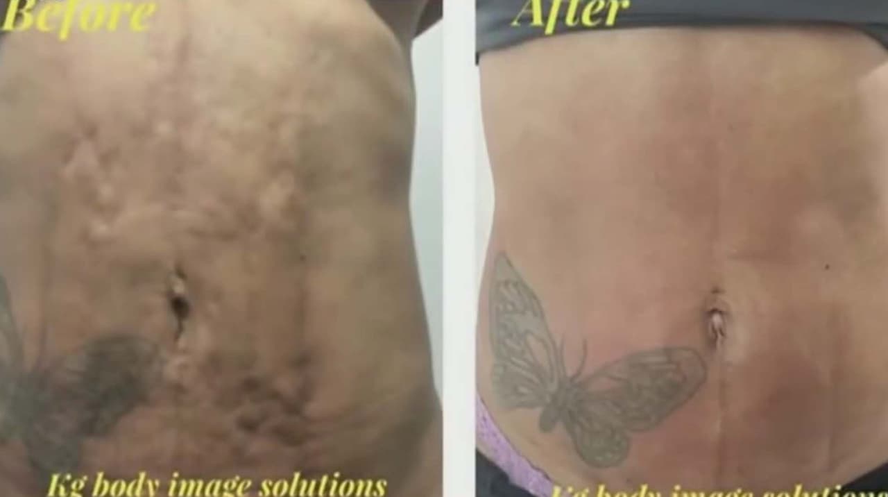 Evita complicaciones tras tu cirugía estética: Cómo detectar el exceso de tejido fibroso a tiempo