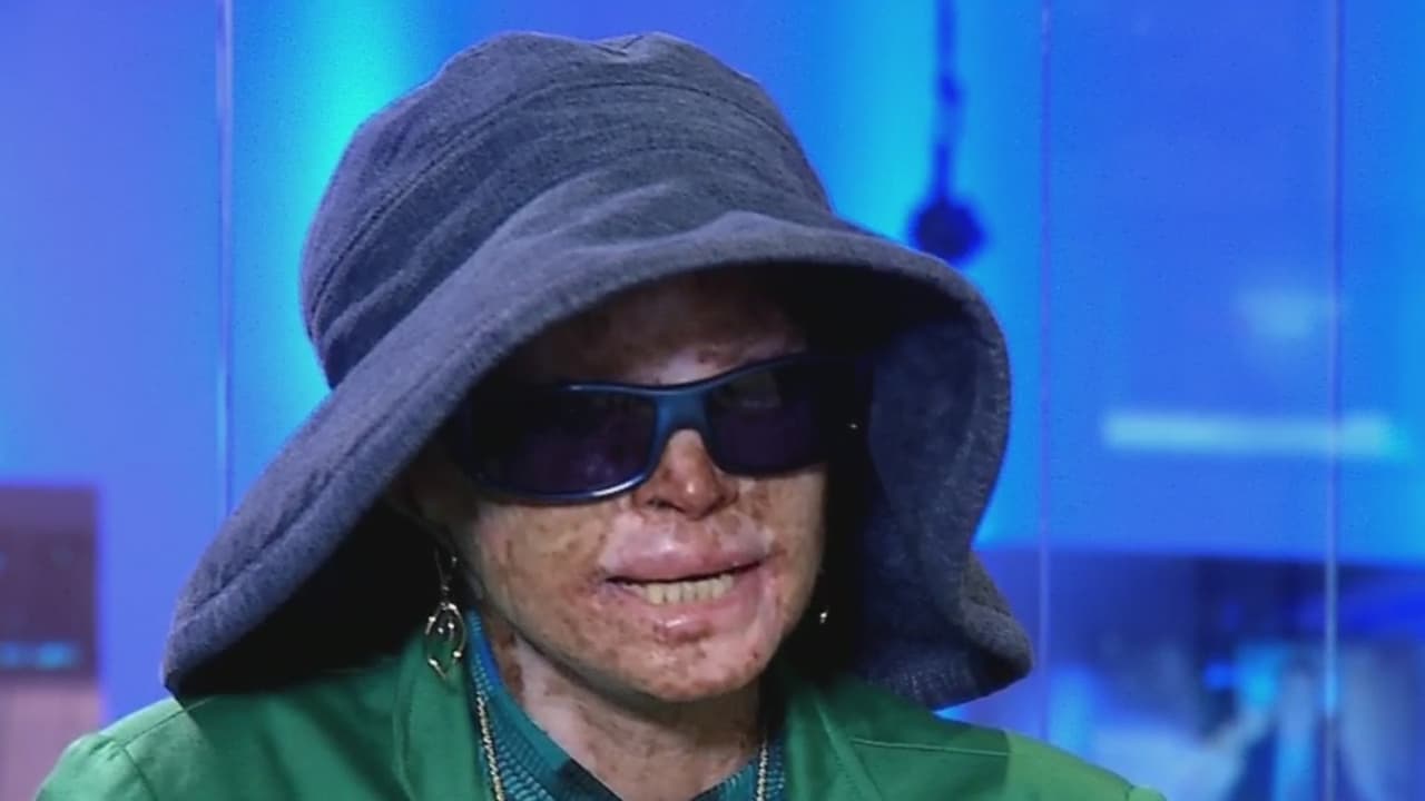 El sol le derrite la piel pero ella lucha incansablemente para ayudar a los que sufren la misma enfermedad