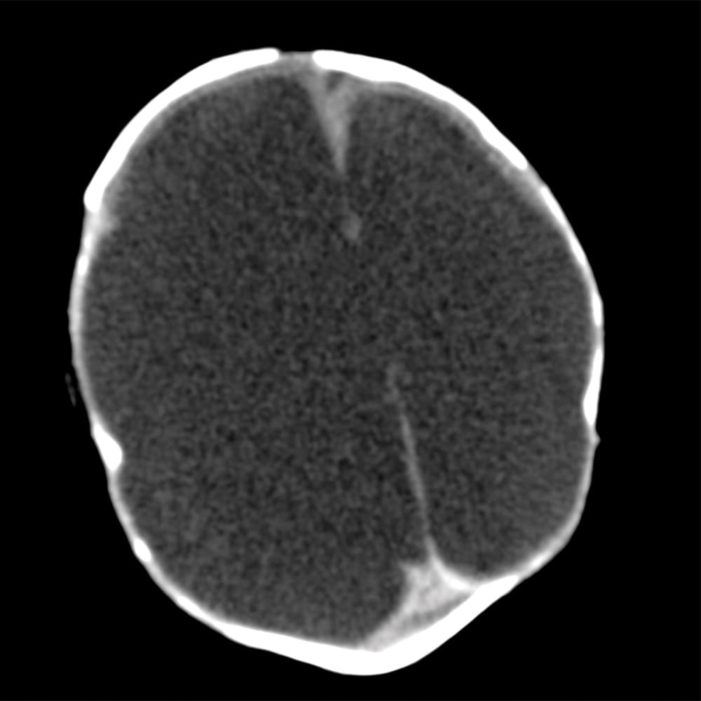 Tiene calcificaciones en el tronco cerebral, cerebelo y disminución en el tamaño de la sustancia gris y blanca.