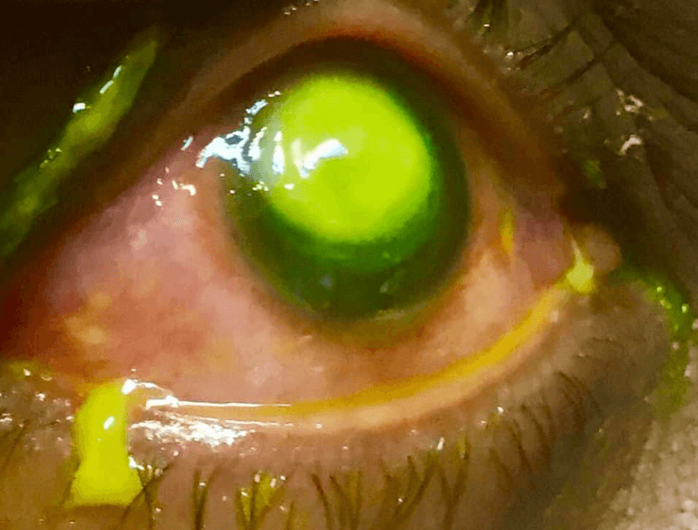 El doctor usó un pigmento verde para que se pueda apreciar el daño a la cornea por la infección con la bacteria.