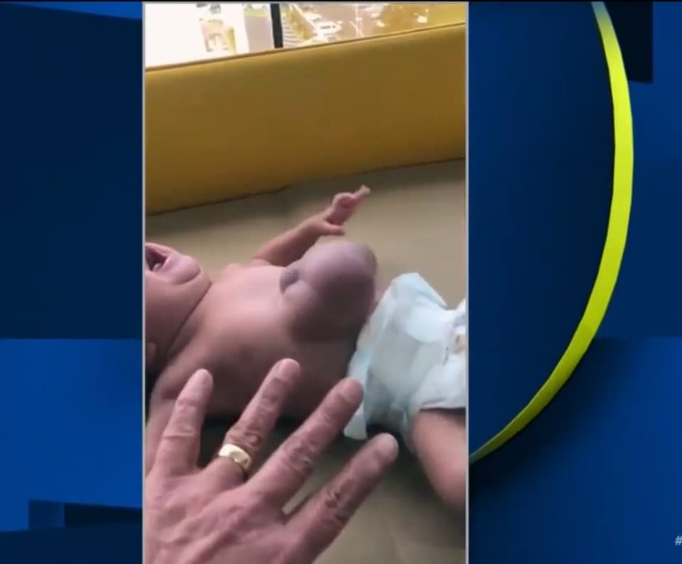 En los 9 meses de embarazo, ningún
<a href="https://www.univision.com/temas/medicina">doctor</a> pudo detectar la malformación de Marcela. Fue en el momento del parto que el médico junto a los padres para avisarle sobre esta anomalía
<b> y les pidió ser conscientes de que su hija no iba a durar muchas horas. </b>
<br>