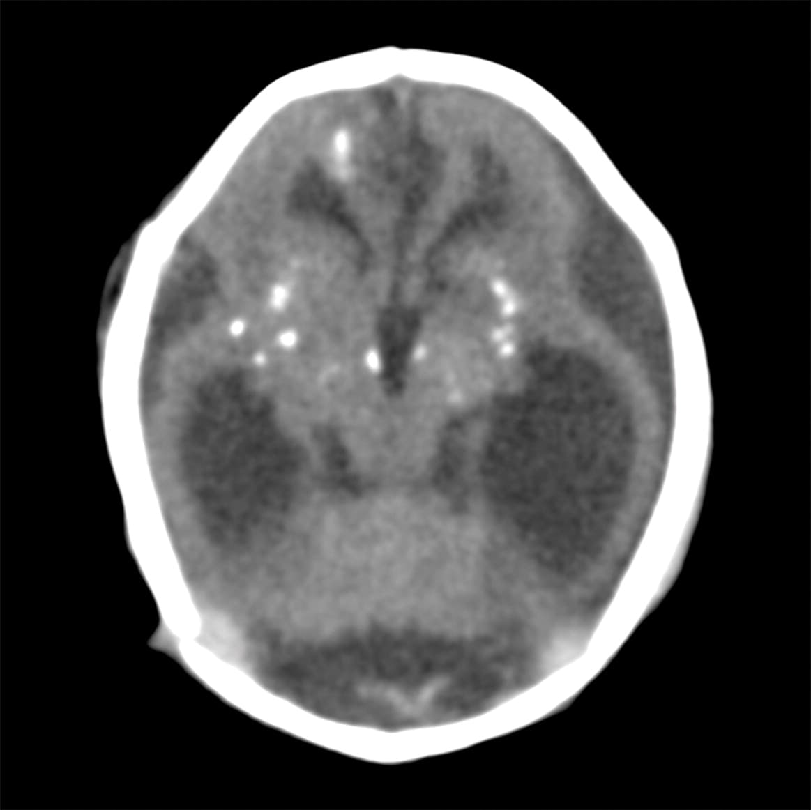 No tenía el cuerpo calloso que conecta ambos hemisferios.