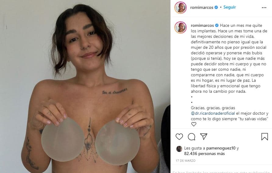 Romi Marcos se quitó sus implantes