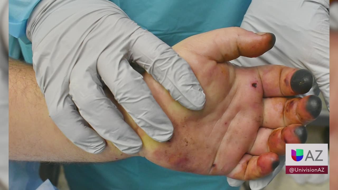 Mucho se habla del golpe de calor, pero expertos aseguran no es de lo único que debemos preocuparnos durante esta temporada, ya que también debemos estar alertas de posible quemaduras.