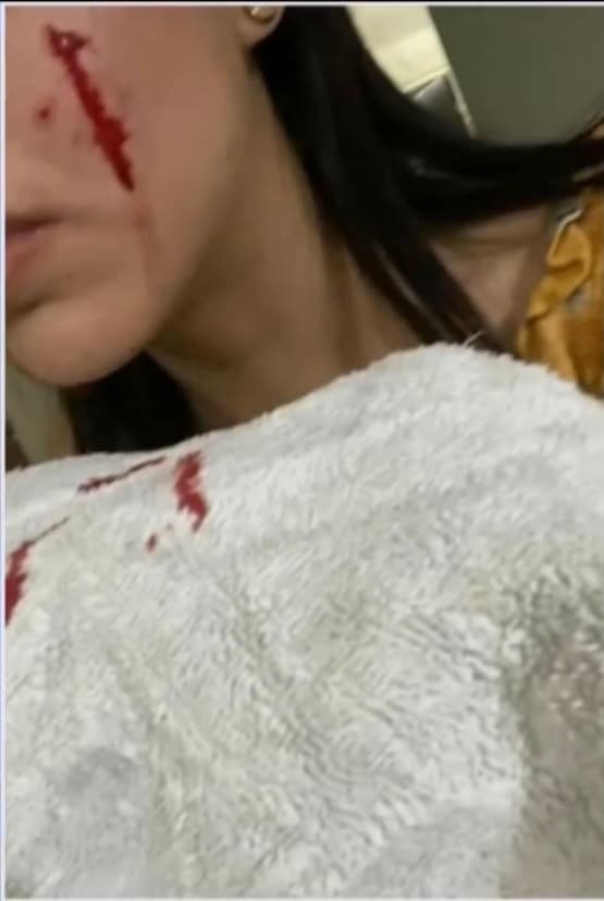 De acuerdo con el testimonio de una joven llamada Adriana, el perro la mordió en su cara y su cuerpo cuando venía de regreso de una farmacia y Rodolfo quería entrar a su casa. 
<b>El enojo del novio de esta mujer fue tanto que decidió tomar un hacha y decapitar al <a href="https://www.univision.com/temas/animales">animal. </a></b>
<br>