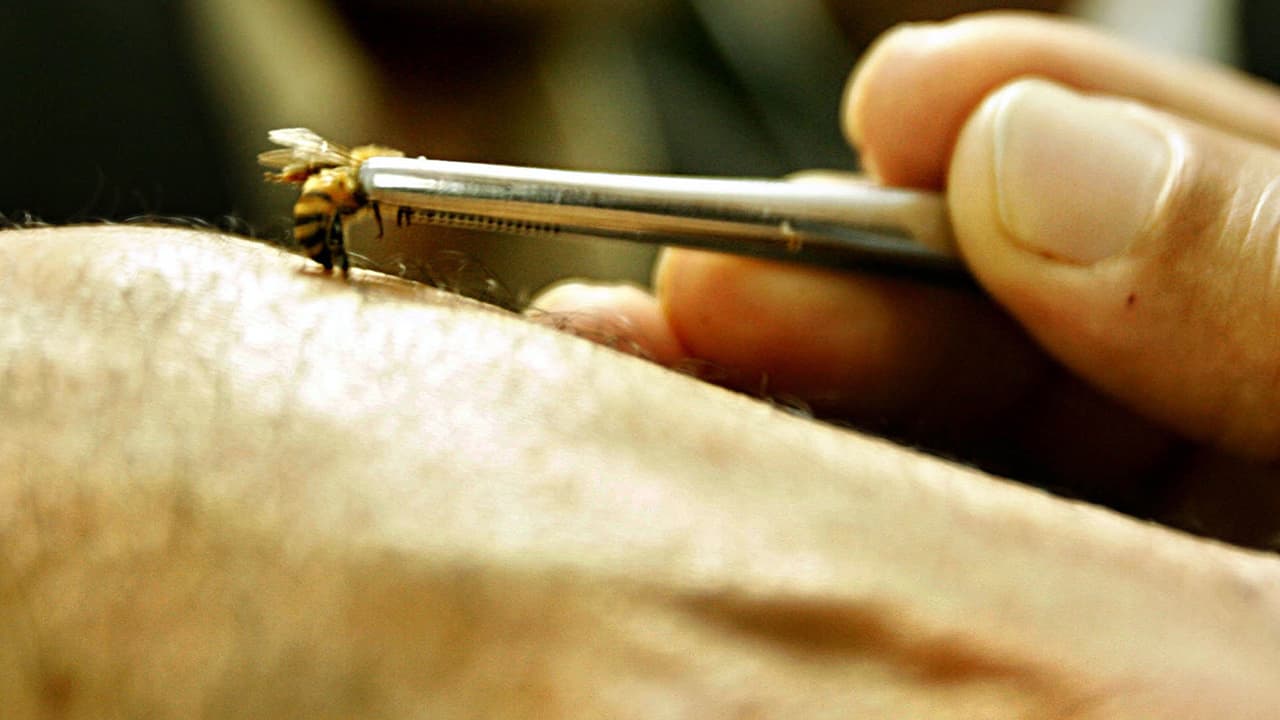 Creía que era una simple infección, pero los médicos le encontraron 4 abejas dentro del ojo