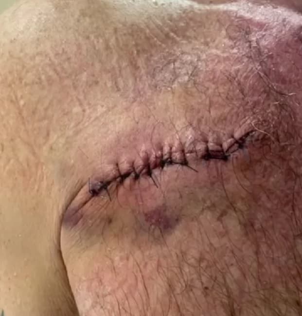 “Ahí me operé, gracias a Dios. Después de la operación se vuelven a hacer otros estudios y sí lo erradicamos por completo”, agregó Julián antes de mostrar la cicatriz que le quedó debajo del hombro.
<br>