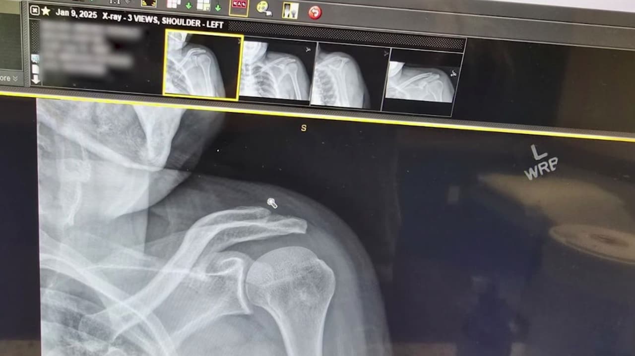 Trabajador en pollería de Gainesville denuncia que sufrió una lesión en el hombro: qué puede hacer