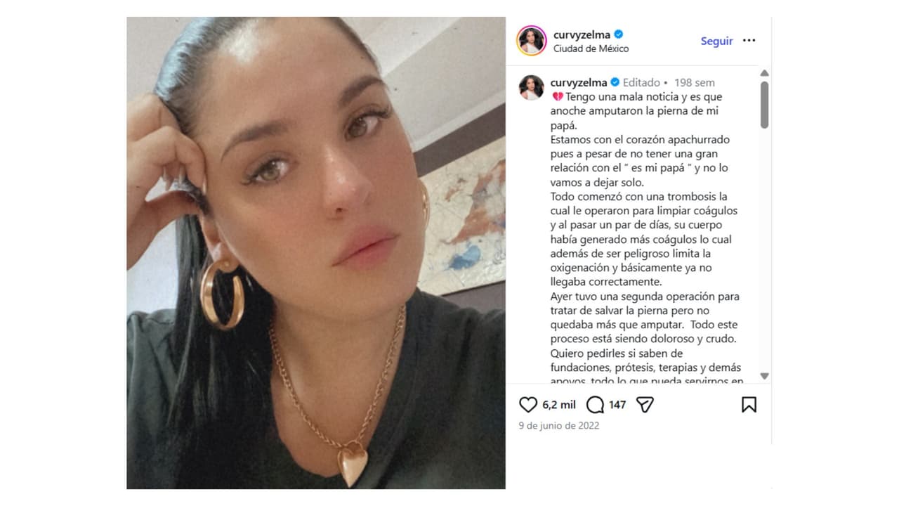 Así reveló Curvy que su padre había sufrido una amputación a consecuencia de una trombosis.