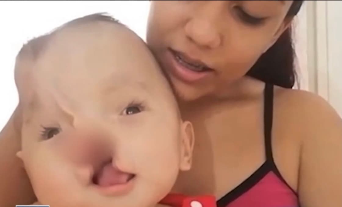 <b>“A los 6 meses de <a href="https://www.univision.com/temas/embarazo">embarazo</a> me dijeron todo lo que tenía”</b>, cuenta Aguilar, quien con 23 años dio a luz a Emiliano un par de meses después y decidió hacer de oídos sordos todas las recomendaciones que le daban para que no trajera al pequeño a este mundo. 
<br>