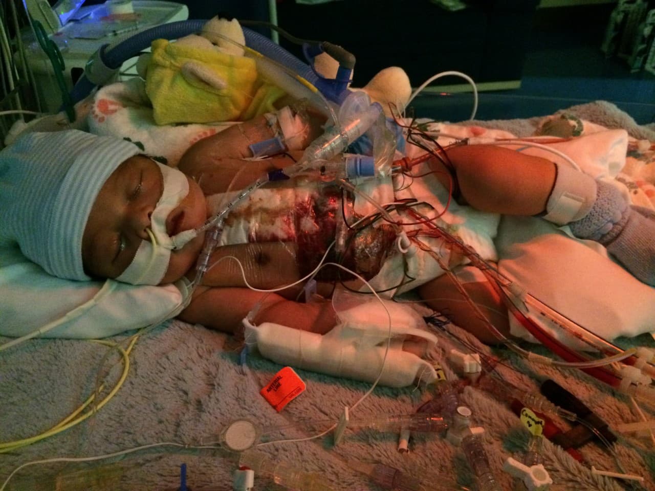 Georgie durante las cirugías pasa tiempo internado en el hospital, pero cuando esta listo para ir a casa, su familia tiene equipo médico para monitorear su salud y en una tableta inteligente.
<br>