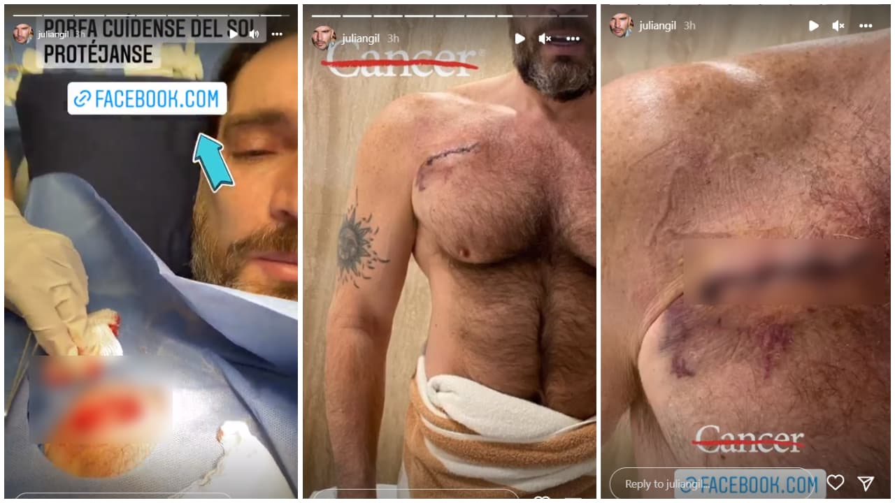 Julián Gil muestra la cicatriz que le dejó el cáncer de piel que le diagnosticaron hace casi dos años.