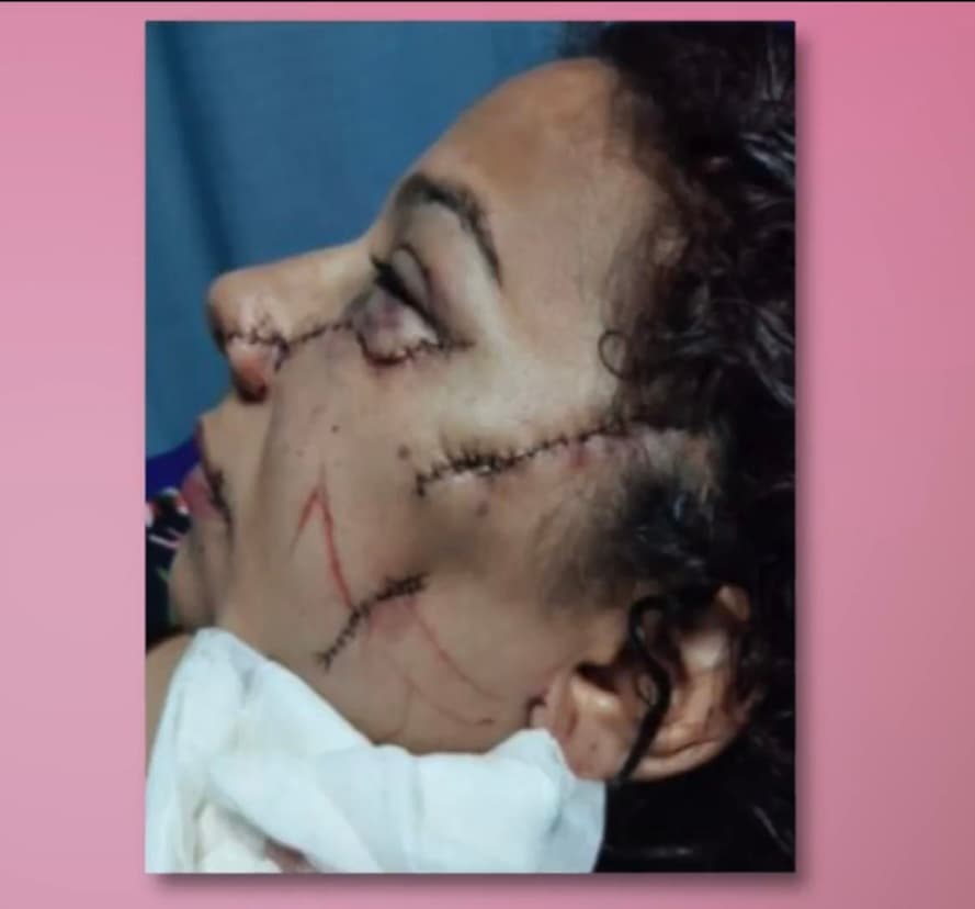 Consciente del esfuerzo que había requerido para alejarse de aquel hombre, de los Santos le dijo que no, provocando la furia de su expareja, 
<b>quien no aceptó ser rechazado y le desconfiguró el rosto con 12 puñaladas. </b>
<br>