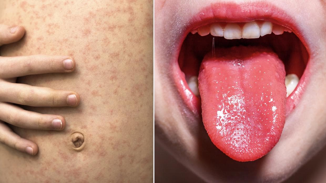 Carolina del Norte monitorea de cerca la enfermedad de Kawasaki y su relación con el coronavirus