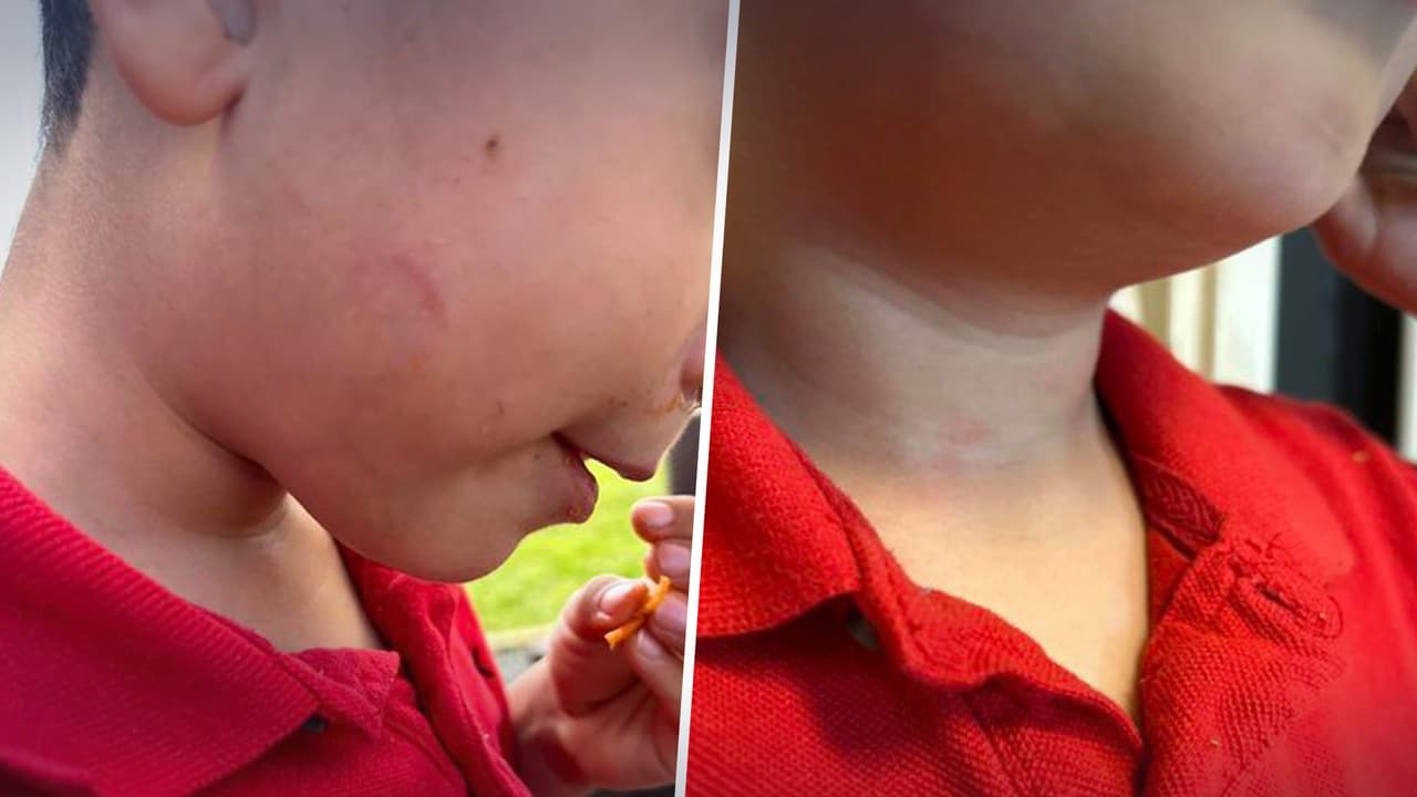 Las marcas rojas en el cuello del menor, foto que tomó su madre cuando lo vió por primera vez luego del incidente.