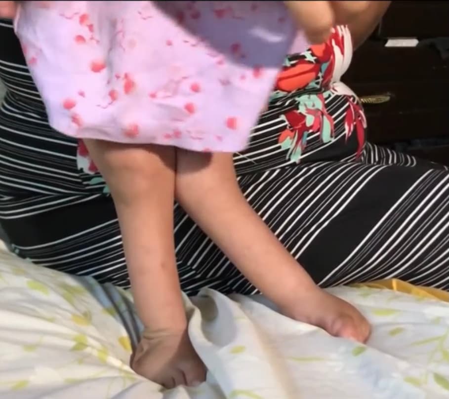 “Cuando nació vimos que
<b>tenía sus piernas dobladitas y me dijeron que con un yeso bastaba para arreglarlo.</b> Pero pasando 3 meses de estar yendo al hospital vimos que los yesos no le corregían nada y que además una rodilla no la podía doblar”, recuerda con angustia Yary.
<br>