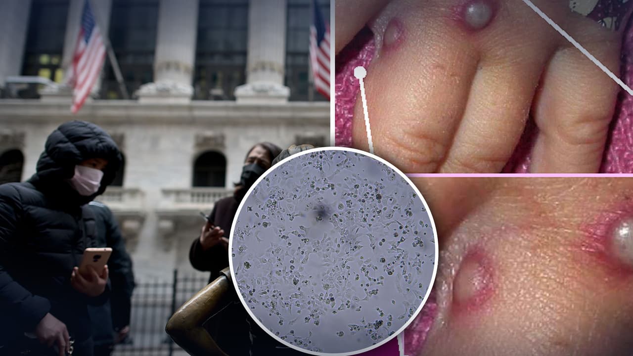 ¿Una persona puede contagiarse de Covid-19 y Viruela del Mono al mismo tiempo? Un médico responde