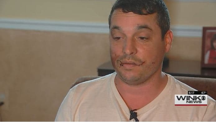 Chris Thompson perdió ocho dientes tras explotarle un cigarrillo electrónico.