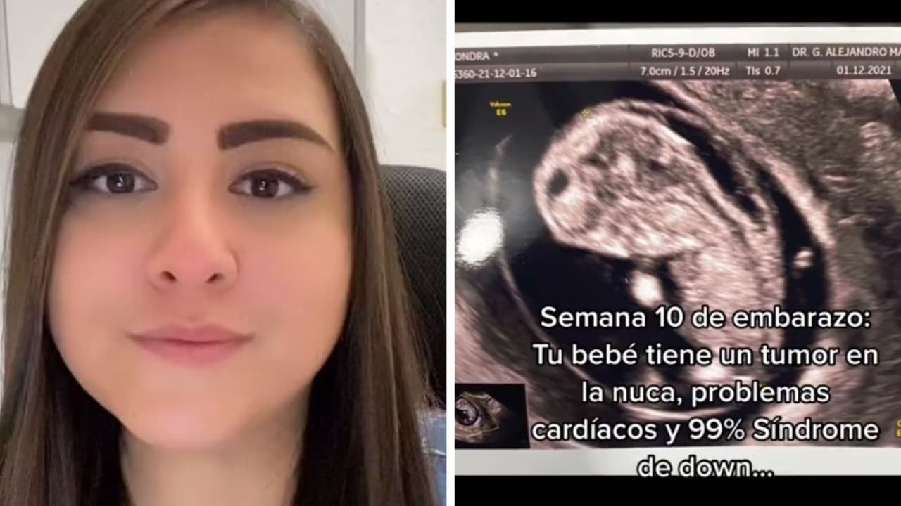 Le dijeron que su bebé nacería con un tumor y Síndrome de Down: no podrás creer lo que pasó