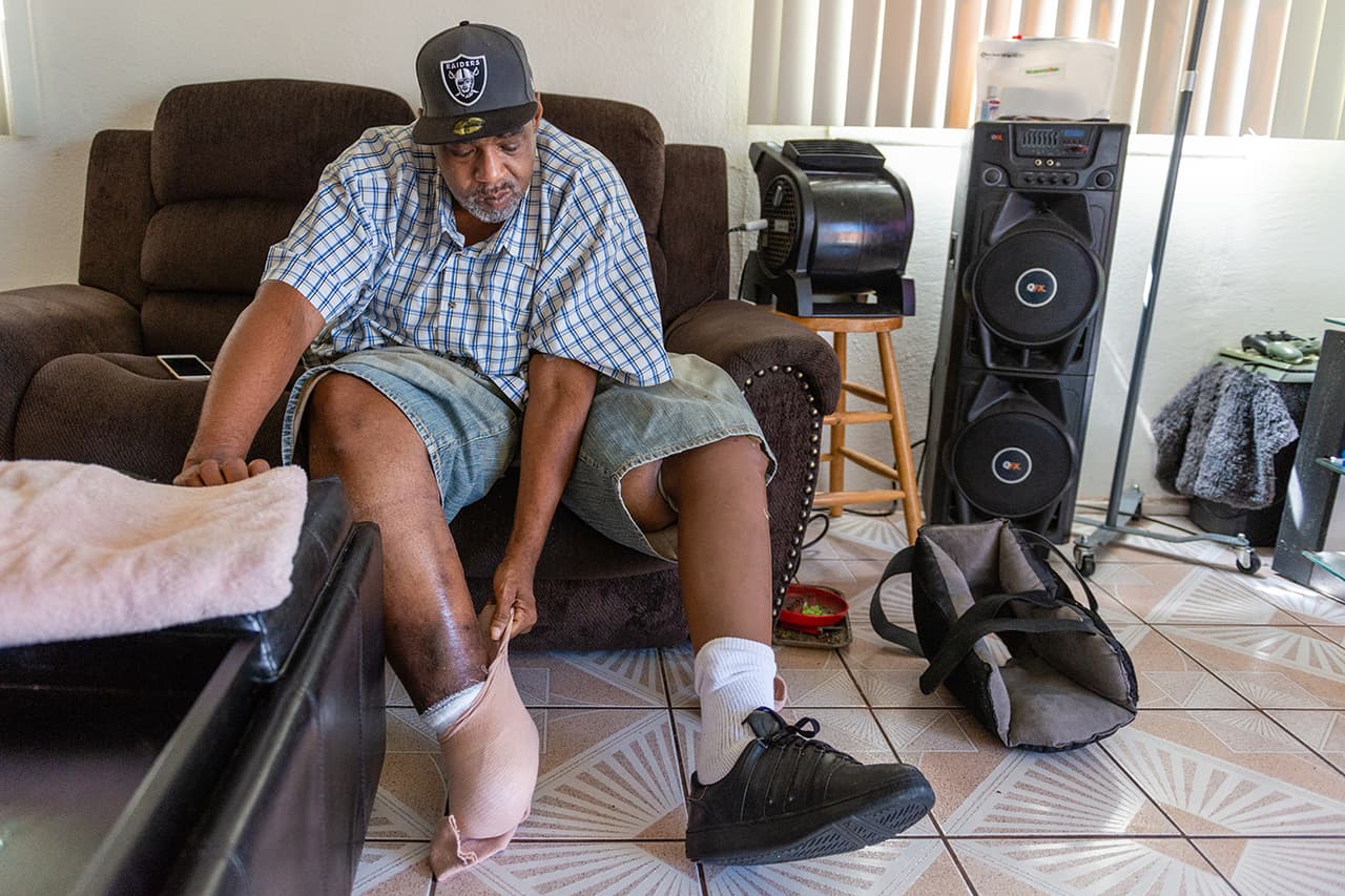 Minorías sufren más amputaciones diabéticas por falta de atención médica