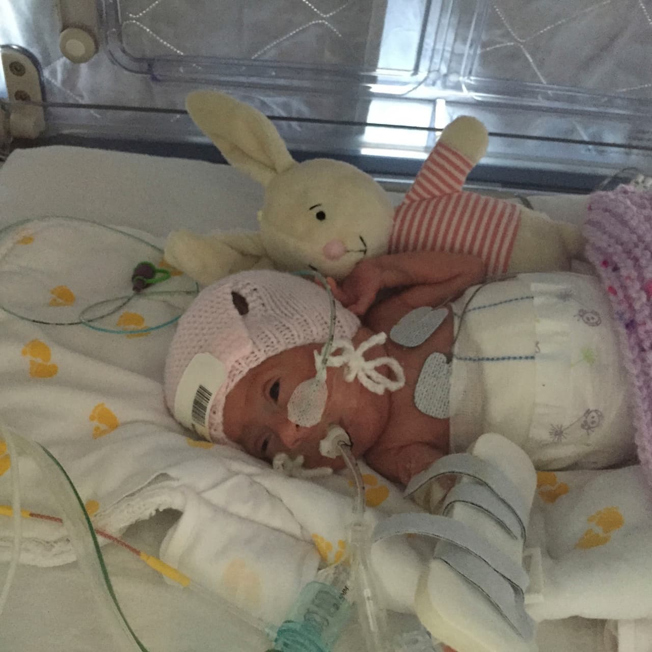 Ava Allen nació con una grave enfermedad pulmonar.