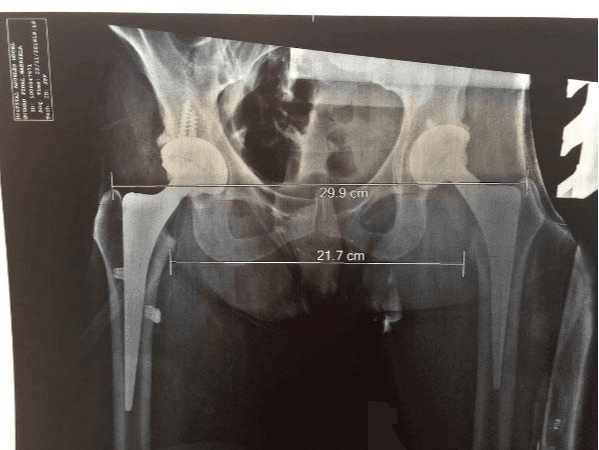 Desde 2014, Alejandra tuvo que vivir con una prótesis de titanio en la cadera.