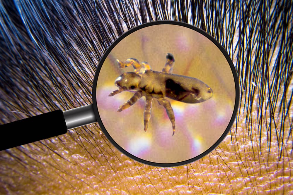 <h3 class="cms-H3-H3">Soñar con piojos en la cabeza</h3>
<br>Pueden ser señales de problemas de baja autoestima, de que alguien no es lo suficientemente bueno para hacer o cumplir algo en su vida. Que tiene bloqueos mentales, por tanto qué pensar o hacer en su día a día.