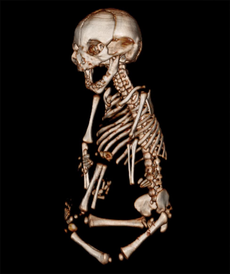 A partir de la semana 21 empezaron a verse signos de que el cerebro del feto no crecía al ritmo debido.