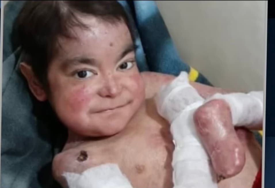 Ángel de Jesús Villalobos es un joven de 18 años que padece de la enfermedad llamada ‘piel de mariposa', un extraño padecimiento degenerativo que ataca poco a poco cada uno de sus órganos. Desde hace más de 17 meses no puede escuchar nada.