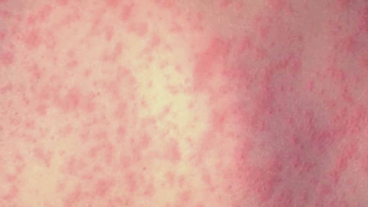 Sarampión en EEUU; pruebas genéticas alertan de propagación silenciosa del virus