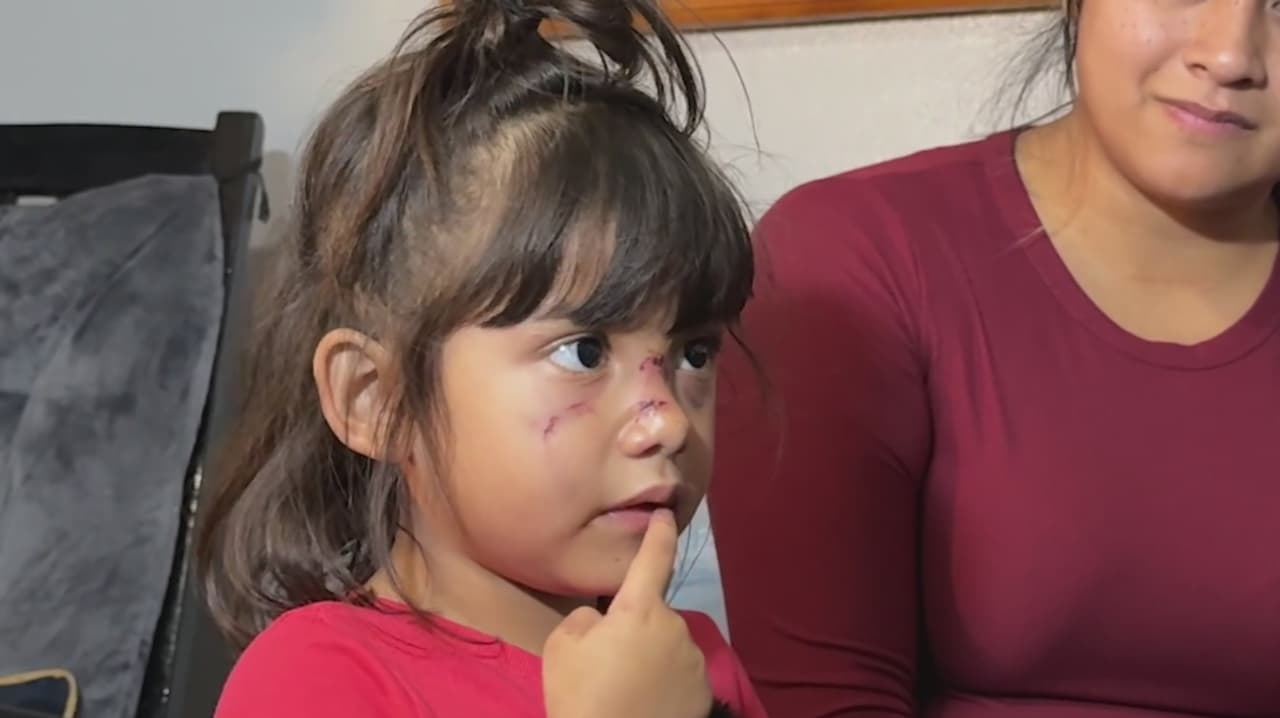 Psicóloga advierte por secuelas tras ataque a niña mordida en el rostro en parque de San Antonio