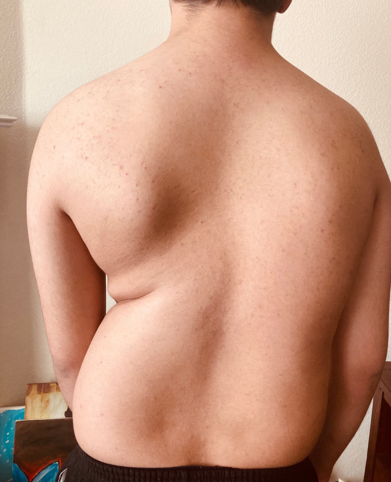 En febrero del 2021 los médicos le dijeron a su madre Mónica que la curva había crecido 20 grados más y los riesgos eran altos.
<br>