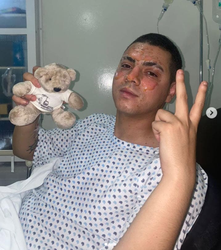 En una publicación posterior, el actor de 25 años colgó fotos ya sin los vendajes y dejó ver las consecuencias de las graves quemaduras que sufrió.
<br>