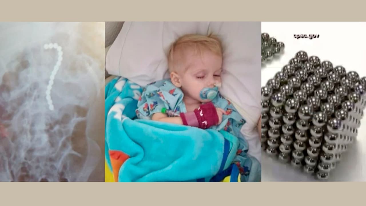 Niño de 2 años es hospitalizado después de tragarse 16 bolas magnéticas