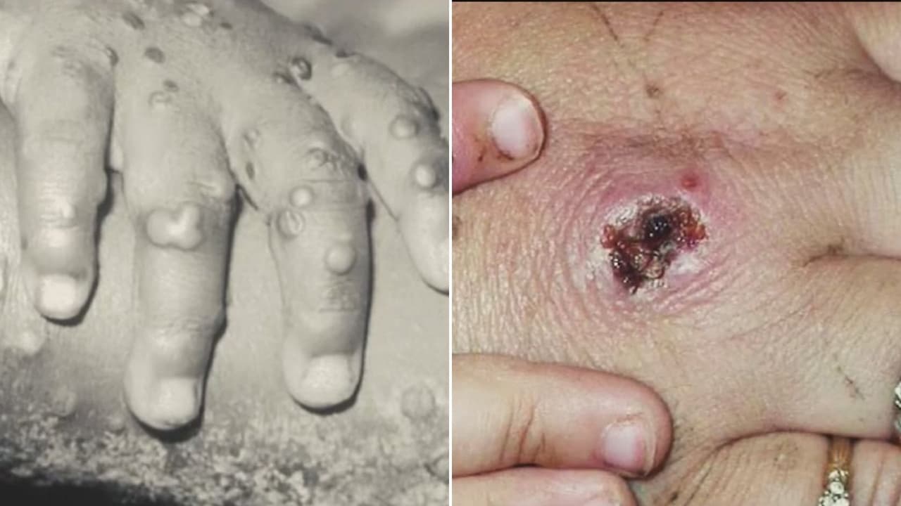 Detectan el primer caso del virus de viruela del mono en el condado de Dallas 