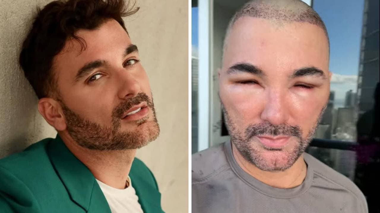 Mauricio Mejía reaparece con "cara de espanto": esto le pasó | Univision Famosos | Univision