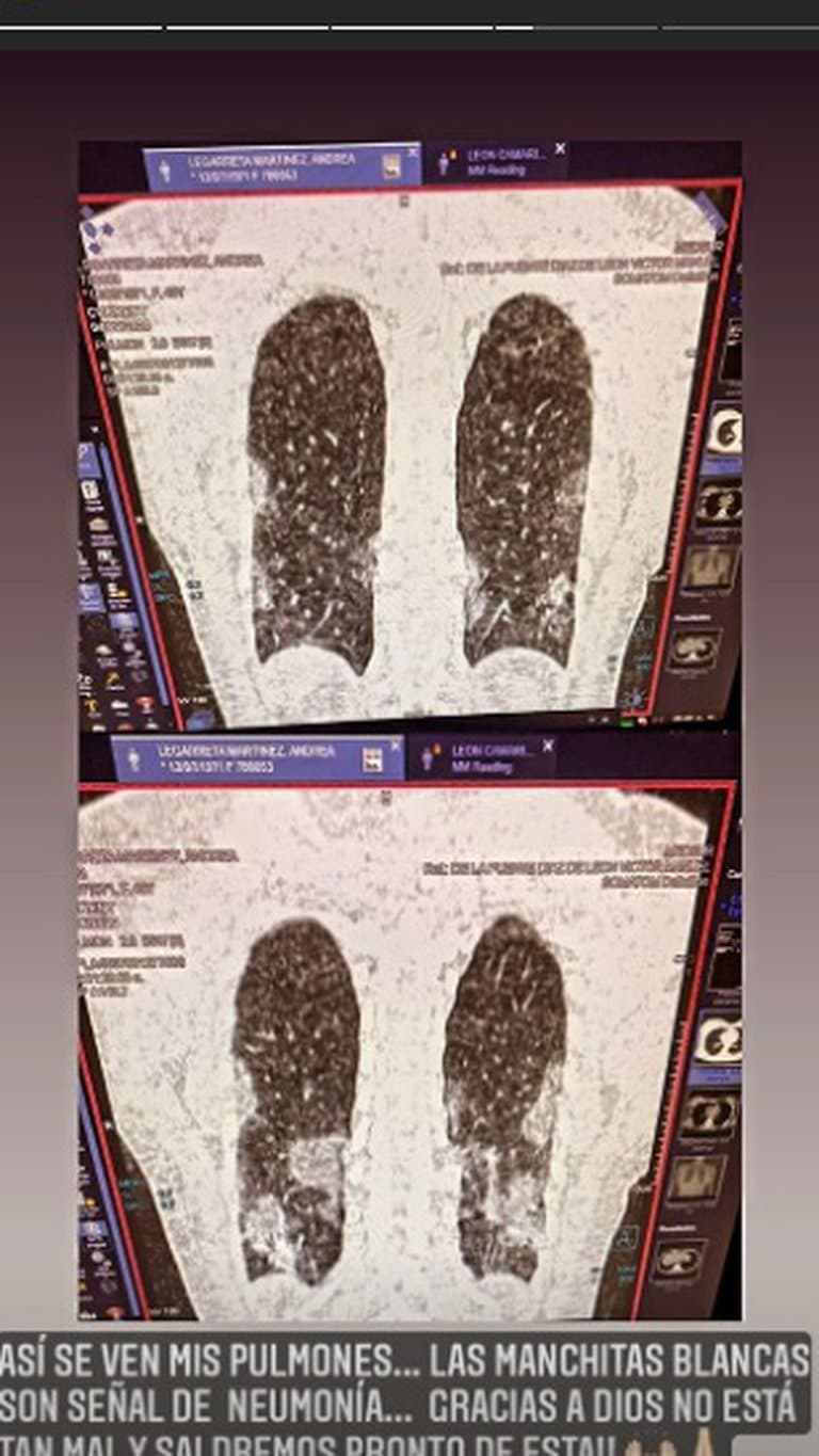 “Así se ven mis pulmones… las manchitas blancas son señal de neumonía. Gracias a Dios no está tan mal y saldremos pronto de ésta”, escribió en sus historias de Instagram.
