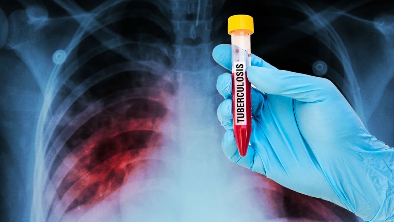 Alerta de salud: Autoridades monitorean caso confirmado de tuberculosis  