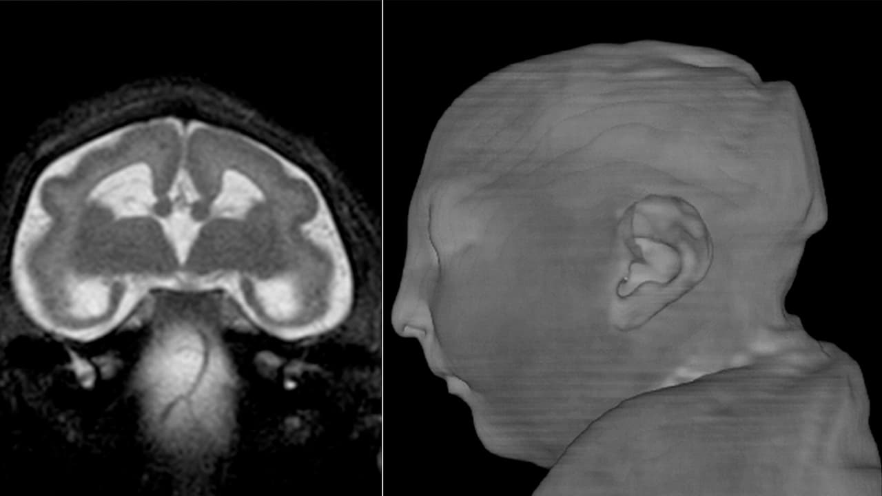 El primer nacimiento de un bebé con microcefalia causada directamente por zika en Puerto Rico sería en noviembre
