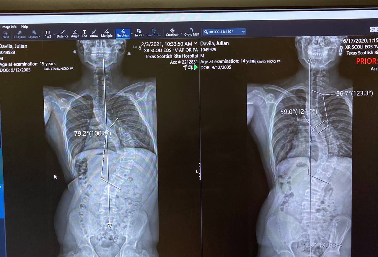 La familia creó una página de GOFUNDME para poder recaudar fondos para los gastos de la operación bajo el nombre de: 
<b>Help get Julian his surgery.</b>
<br>