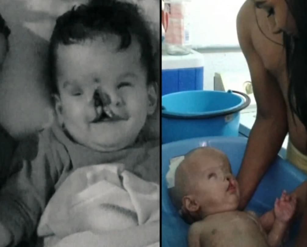 La venezolana recuerda que, tras verlo de lejos en el parto, los doctores le dijeron que su pequeño Thiago había nacido sin visión, con el labio y paladar hundidos y que 
<b>“era muy poco probable que siguiera viviendo”</b>, sobre todo porque también había nacido de forma prematura. 
<br>