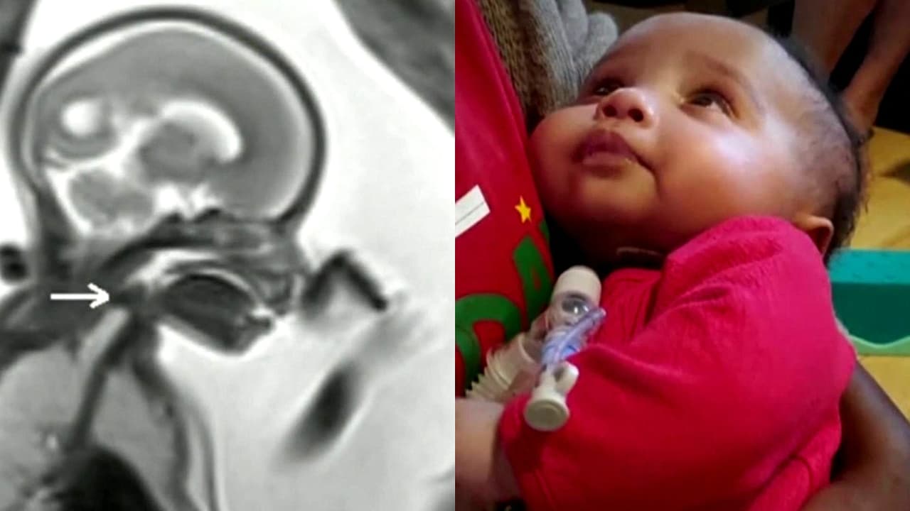 Florida | Realizan cirugía pionera a bebé en vientre materno y “nace” dos veces; conoce la historia