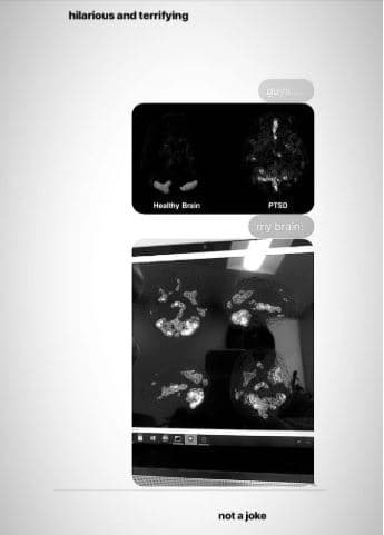 La cantante de 25 años publicó diversas resonancias magnéticas comparando un cerebro en condiciones normales con otro que ha sido afectado por el estrés postraumático y con el suyo. En los cerebros de afectados con el trastorno, se iluminan diversas áreas, mientras que en el cerebro sano, apenas se detecta luminosidad.