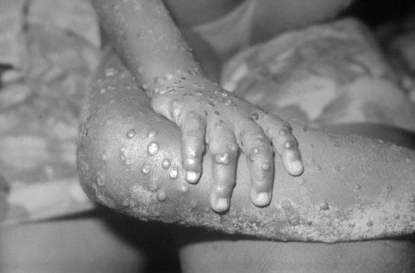 Monkey Pox Lesions 