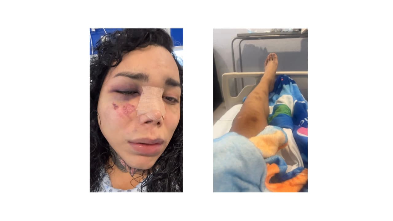 Paola Suárez muestra algunas de sus heridas en Instagram.