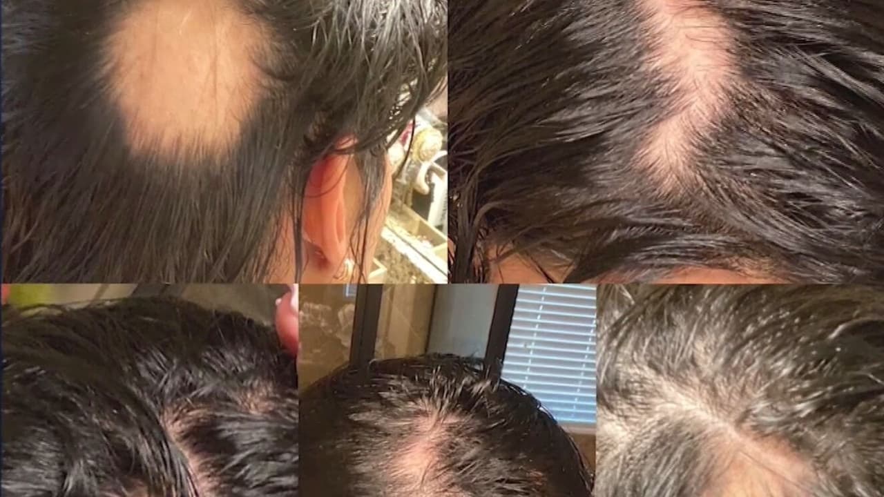 La doctora Cris Berlingeri explica que la causa de la pérdida de cabello no es propiamente el virus, sino el estrés que se experimenta mientras el contagio. La dermatóloga asegura que esta caída “va a ocurrir alrededor de los cuatro meses luego del estrés que pasó” y que no debes alarmarte ya que la pérdida es reversible.