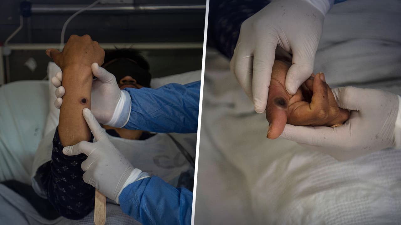 Esto se sabe de la muerte de una persona en Texas que tenía viruela del mono y otras "enfermedades severas"