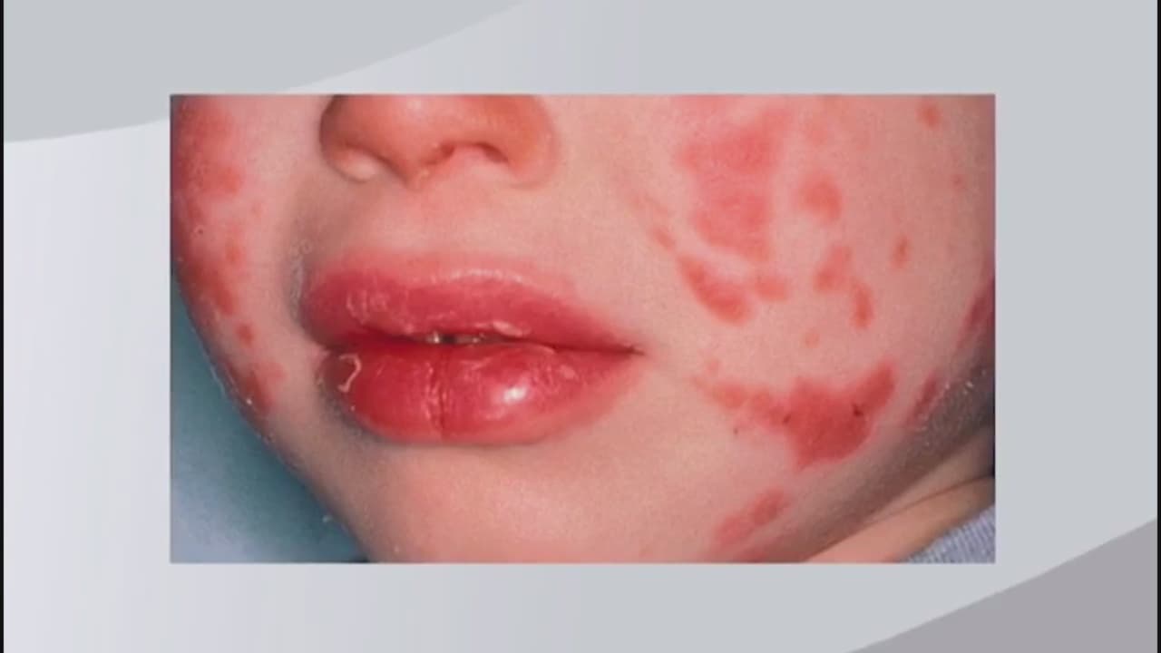 Expertos analizan vínculo entre misteriosa enfermedad en niños en Atlanta y el coronavirus