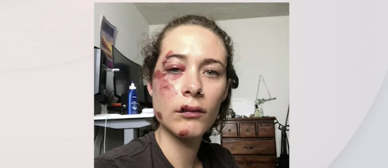 Mujer casi pierde la vida al caerse de una patineta eléctrica en Miami